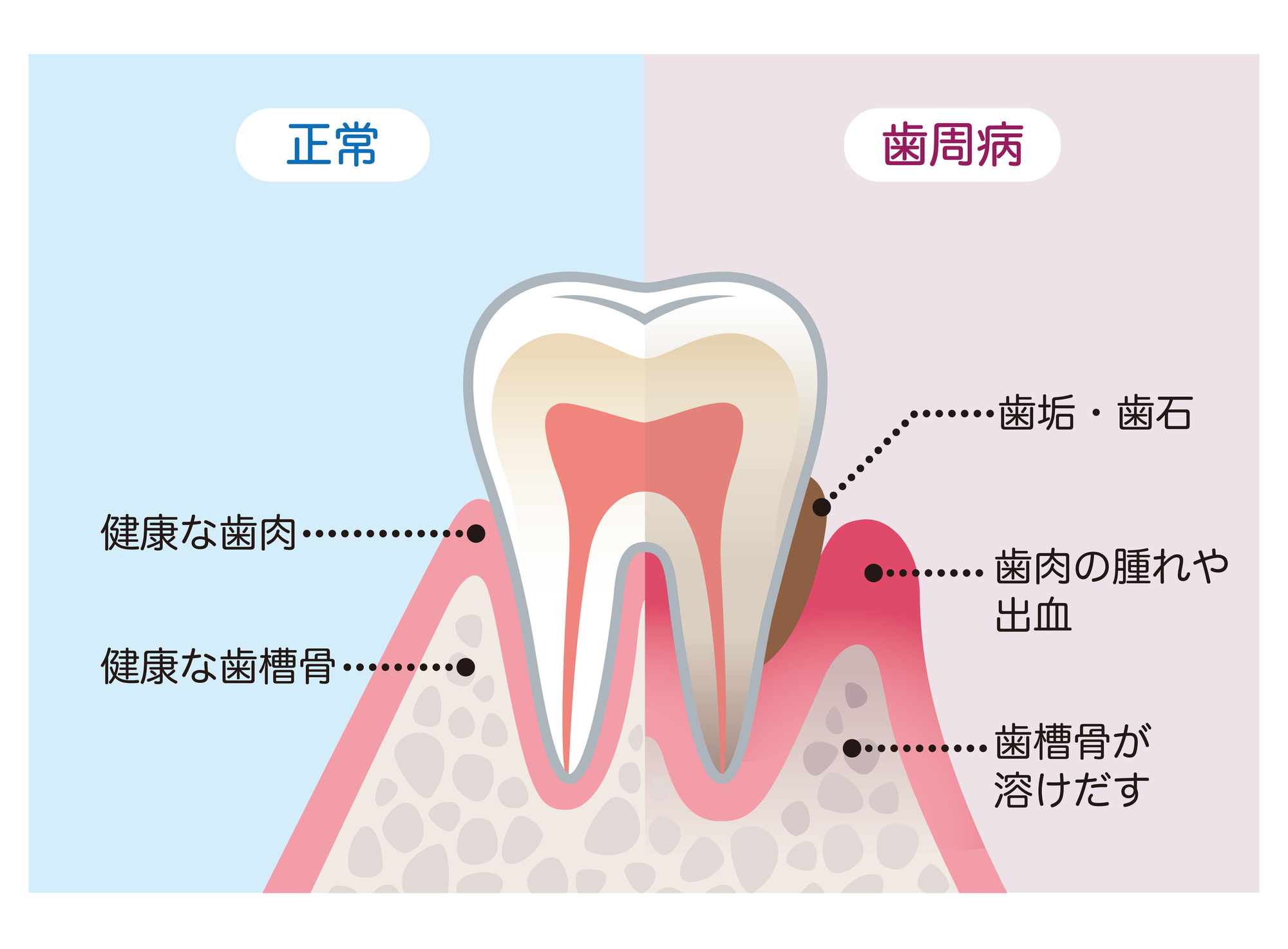 再発させないための予防歯科